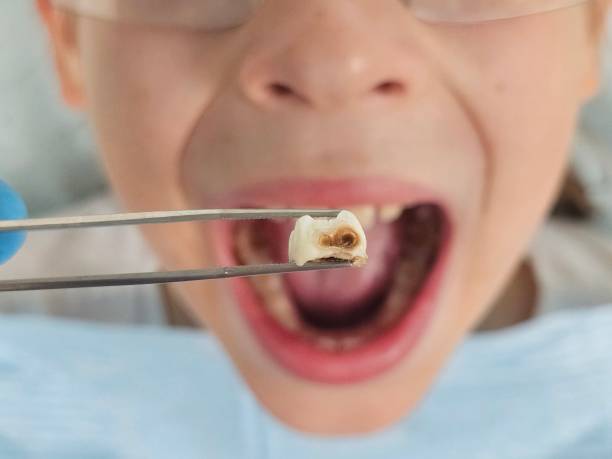 Best Emergency Tooth Extraction  in Gramercy, LA